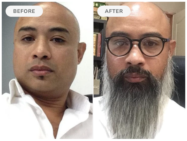 Before and after — 90 days of Beard Boost