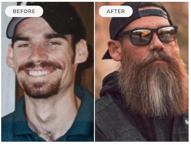 Before and after — 90 days of Beard Boost