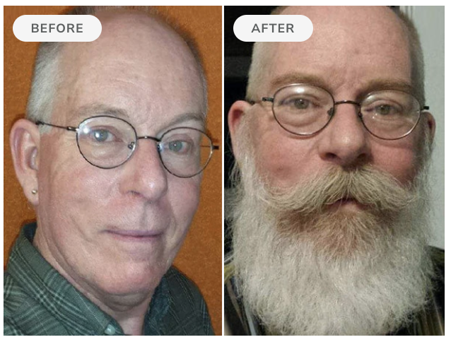 Before and after — 90 days of Beard Boost